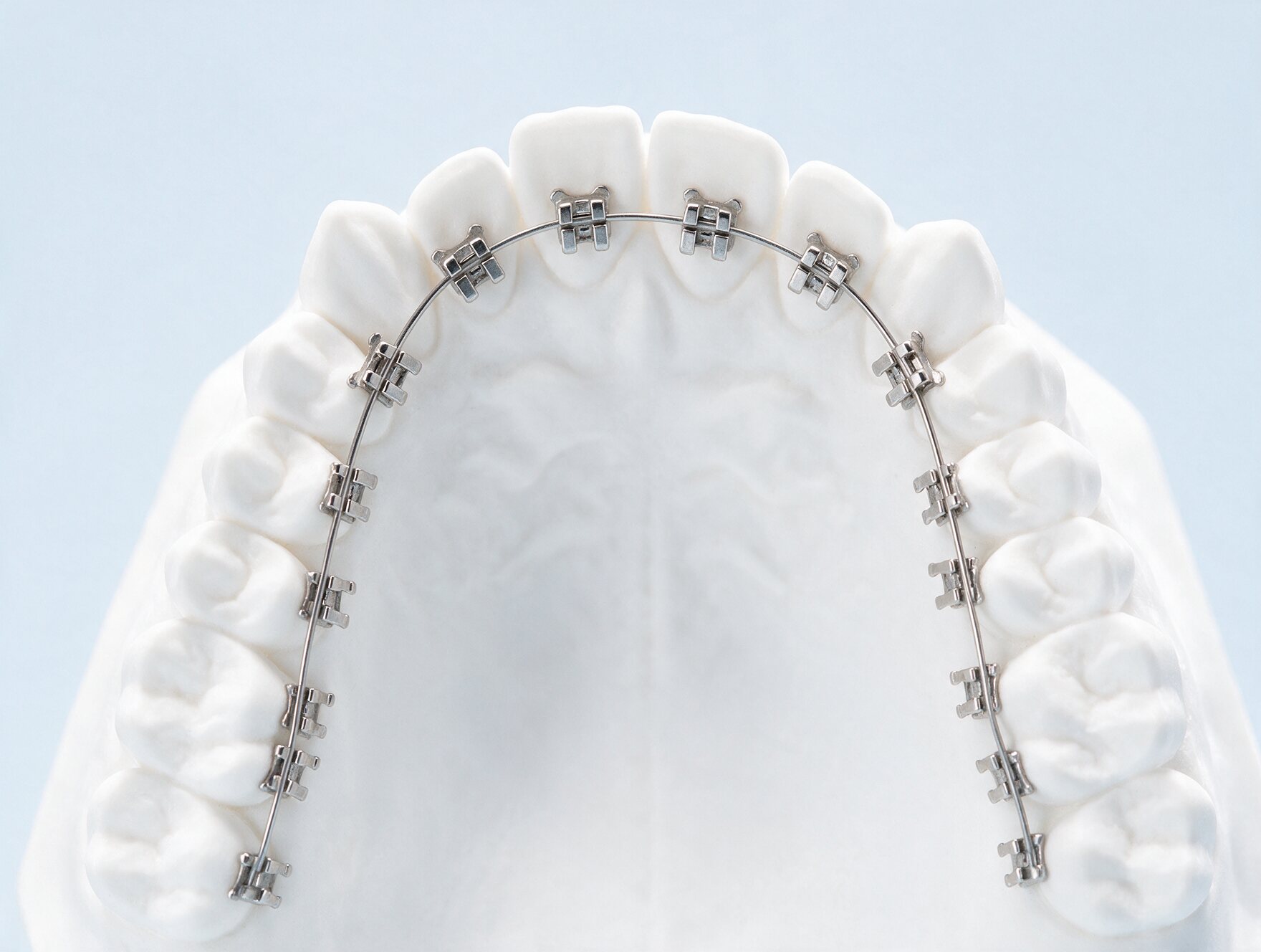 Lingual braces fitted to the inner surface of a dental model